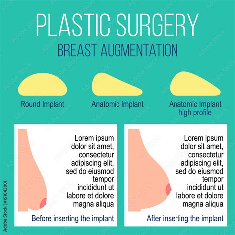 Breast Augmentation Before and After Photos 